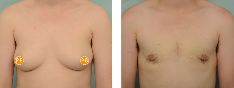 Female to Male Surgery