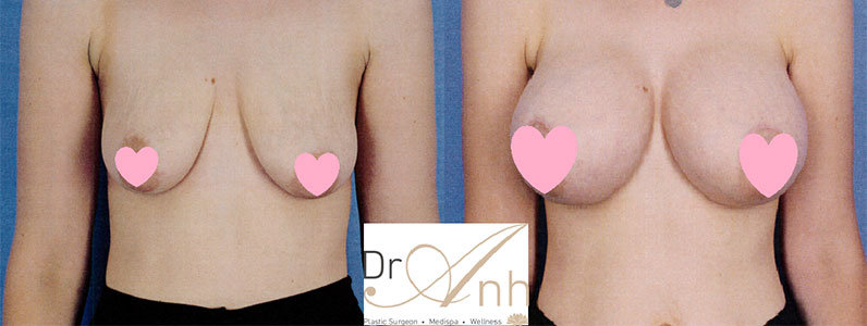 Jess' Breast Augmentation