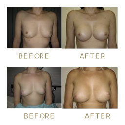 Breast Augmentation - before & after