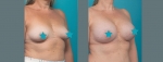 AdipSculpt - fat transfer to breasts