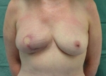 Farhadieh - Breast Reconstruction