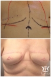 Farhadieh - Breast Reconstruction