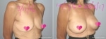 Breast Augmentation by Dr James Gaffield