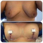 Breast Augmentation by Dr Pouria Moradi