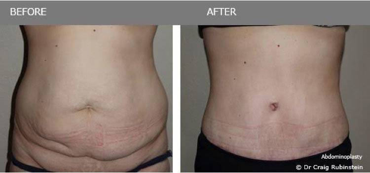 Nadia's Abdominoplasty - before & after