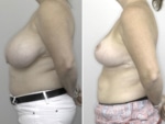 Dr Justin Perron - Breast Reduction