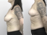 Dr Justin Perron - Breast Reduction
