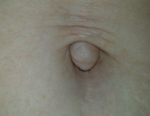 Rachel's belly button surgery