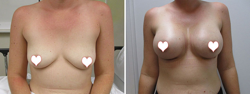 Dr Mark Vucak - Breast Augmentation