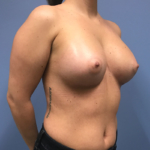 Breast Augmentation - 3 months