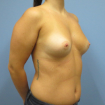 Breast Augmentation - before