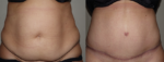 Dr Craig Rubinstein Tummy Tuck Results - Olivia's Patient Story after having kids