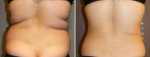 enCurve - getting rid of fat without surgery