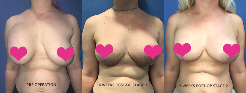 Megan’s Breast Surgery Patient Story - a warning to to “Do Your Research”
