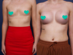 breast implant rotation
