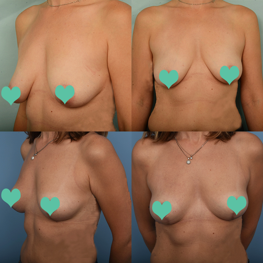 Breast LIft Patient Story