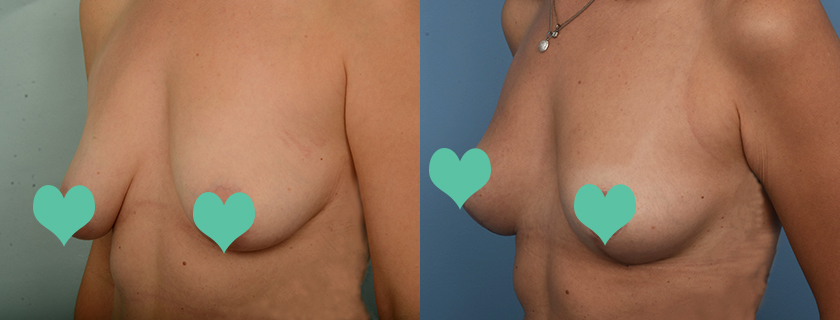 aura’s Breast Lift Patient Story with Dr Briggs