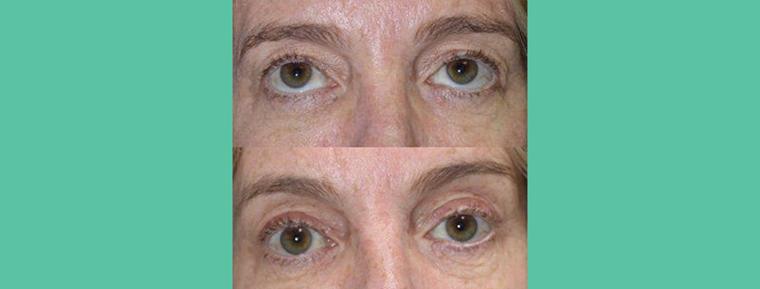 Blepharoplasty and Brow Lift
