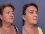 facelift and necklift