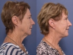 facelift and necklift