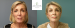 Annette Turns Back Time with Sydney Plastic Surgeon