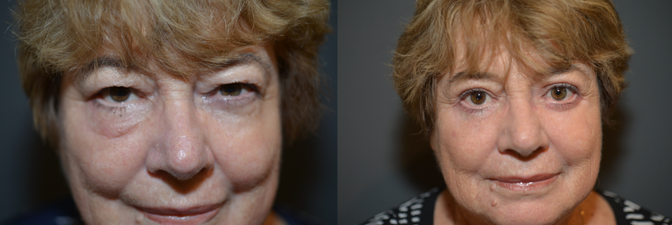 Facelift Packages
