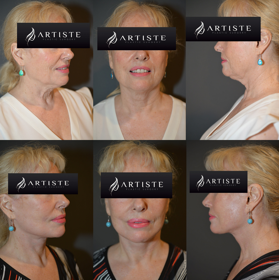 Facelift Packages