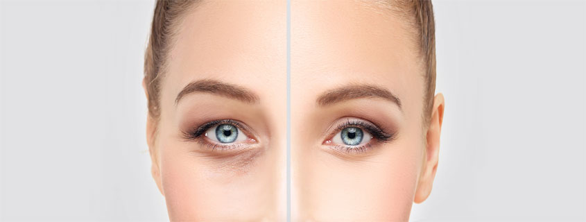 eyelid surgery recovery tips