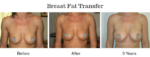 Breast Implant Screening Service - Breast Fat Transfer option