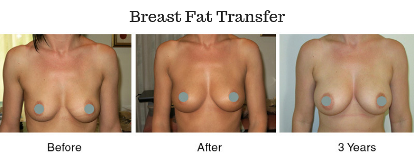 Breast Implant Screening Service - Breast Fat Transfer option