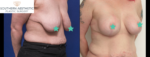 Michelle's Tummy Tuck
