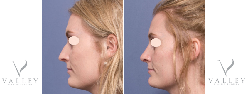 Dr Raymond Goh Talks Rhinoplasty