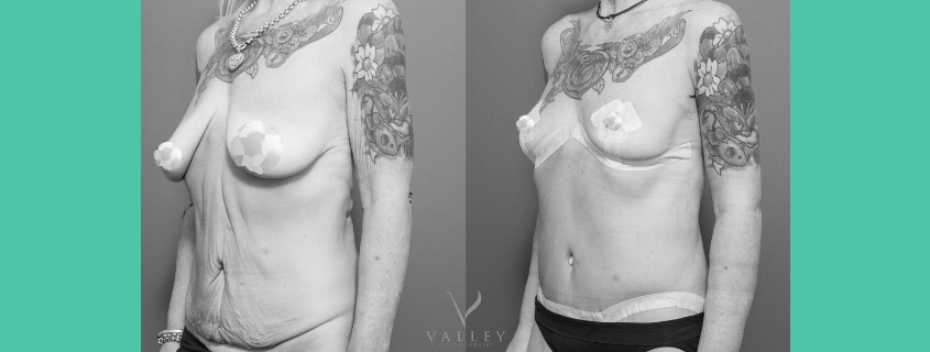 Combining Procedures - Yvonne's Excess Skin Removal