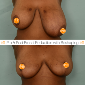 Breast Reduction Perth