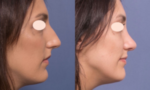 Rhinoplasty in Brisbane by Dr Raymond Goh from Valley Plastic Surgery