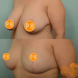 Breast Reduction Perth