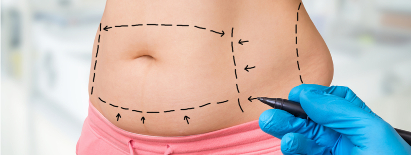 4 Key Differences Between a Full & Mini Tummy Tuck