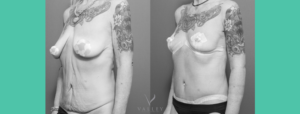 breast reduction lift