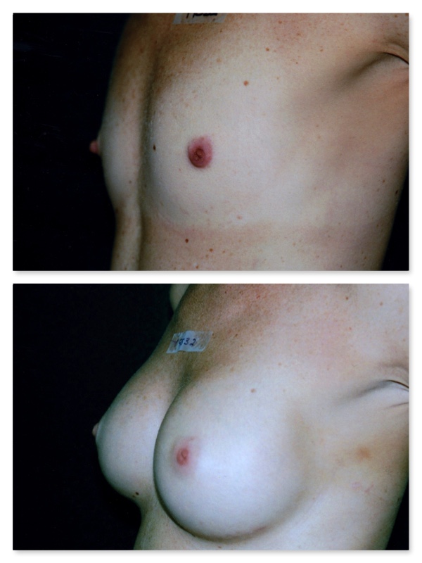 breast nipple deformity
