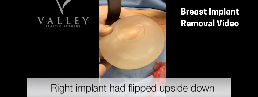 Breast Implant Removal