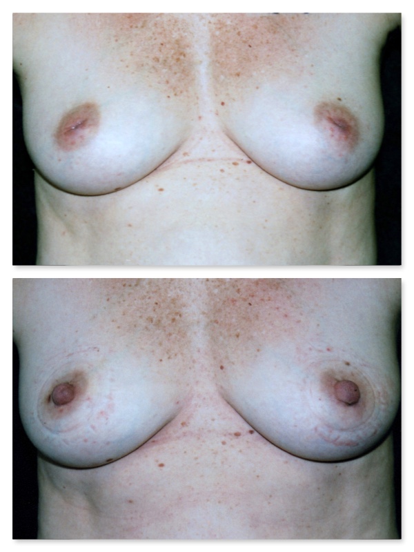 breast nipple deformity
