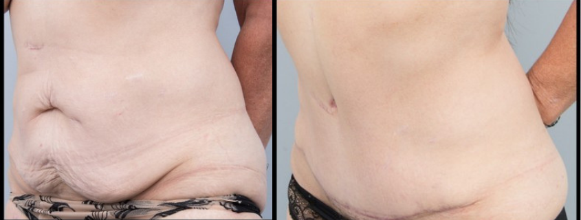 Weight Loss Excess Skin