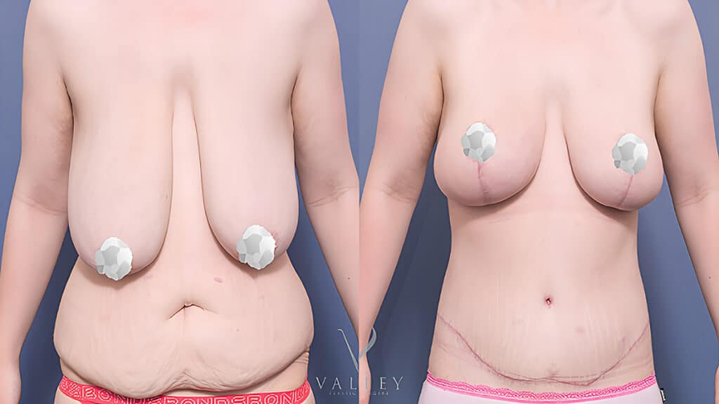 Sharni’s breast reduction and lift, belt lipectomy and mons lift - Plastic Surgery Hub