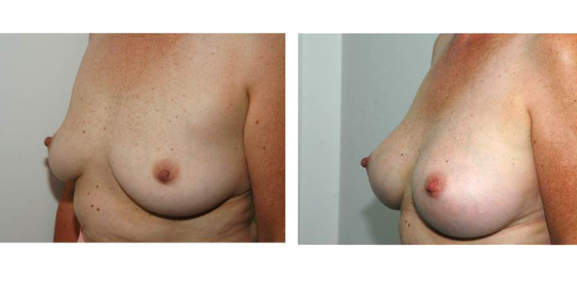 Breast Augmenation