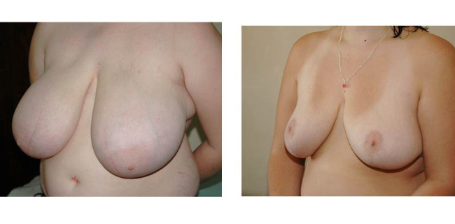 Breast Augmentation and Lift