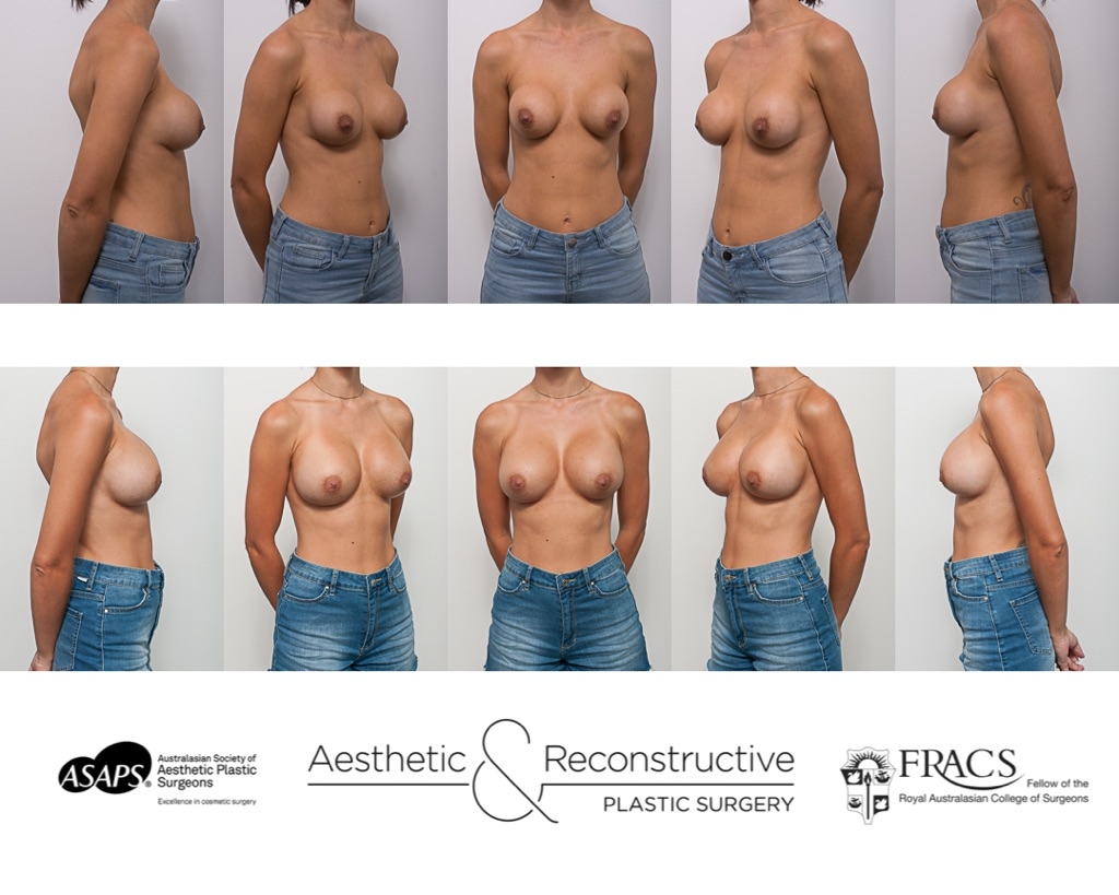 breast implant revision
