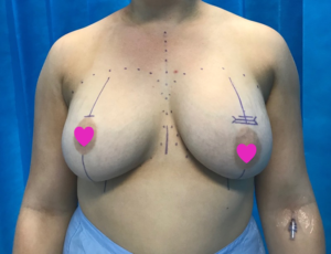 Breast Implants Removal and Replacement