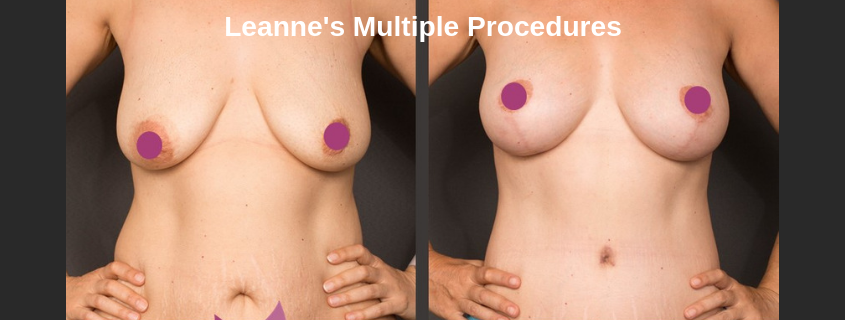 Leannes Multiple Procedures