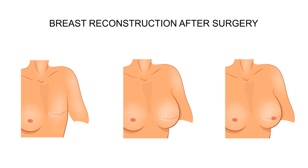 Oncoplastic Surgery