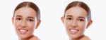 otoplasty surgery before and after 01